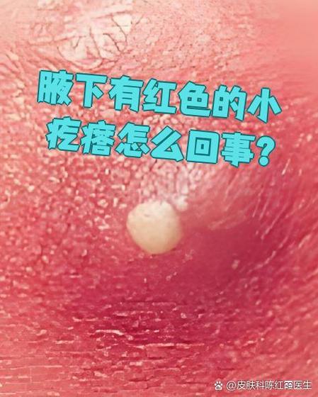 隐私长了红色疙瘩缩略图