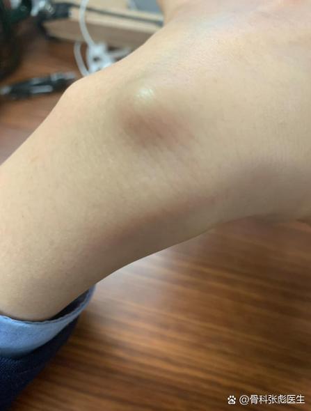 手背上长了个凸起的包缩略图