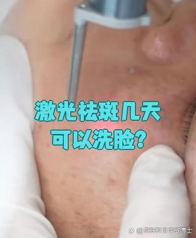 激光祛斑几天可以洗脸缩略图