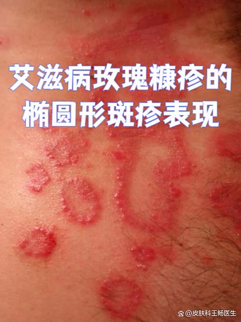 艾滋病多久能知道自己得了艾滋病缩略图