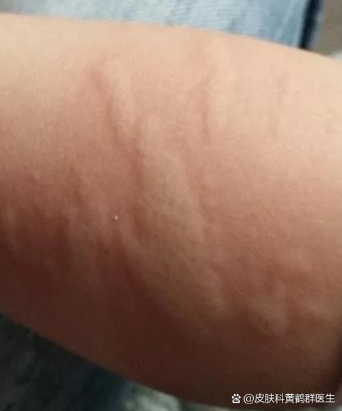 身上一挠痒痒就起疙瘩缩略图