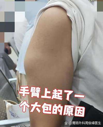 身上长大包硬硬的一坨缩略图