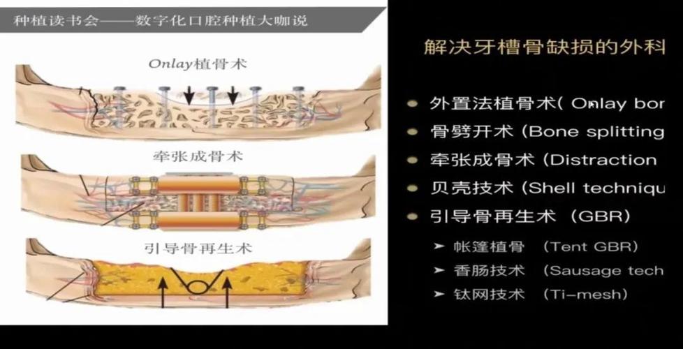 植骨是什么意思缩略图