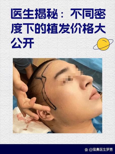 为什么医生不建议植发缩略图