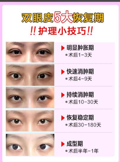割双眼皮怎么消肿最快最有效游戏截图