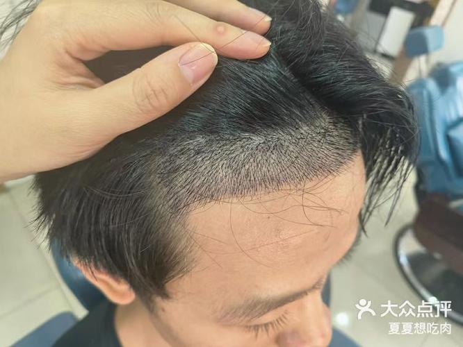 为什么不建议植发游戏截图