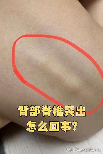后背长了一个凸起硬包游戏截图