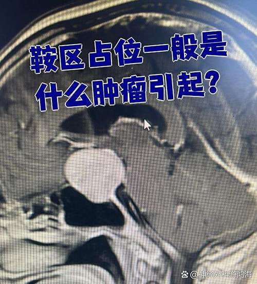 鞍上区肿瘤有哪些游戏截图