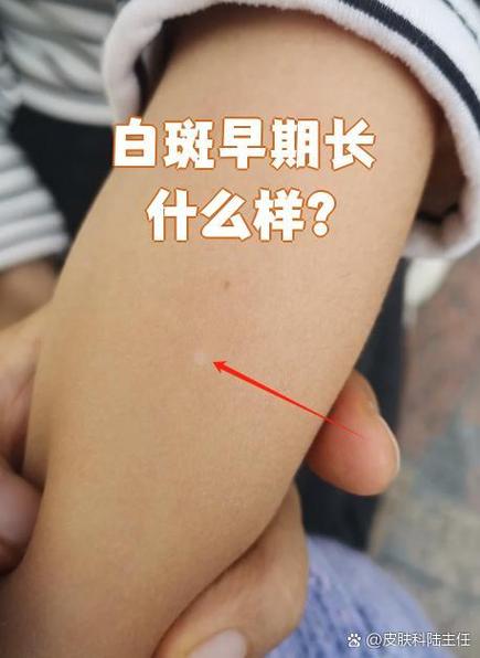 皮肤有白斑图片大全缩略图