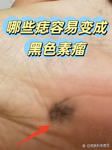 扫一扫识别痣缩略图