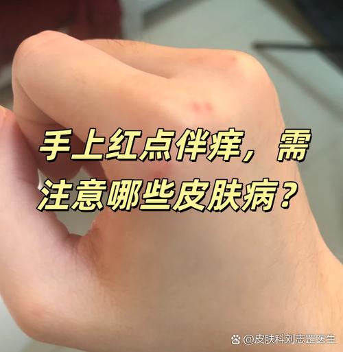 皮肤长红点像血痣不痛不痒缩略图