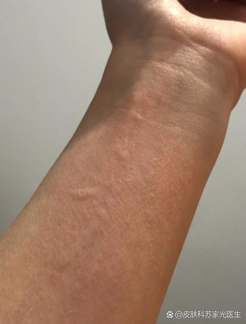 一抓皮肤就起疙瘩奇痒游戏截图