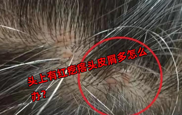头皮上红色的小疙瘩缩略图