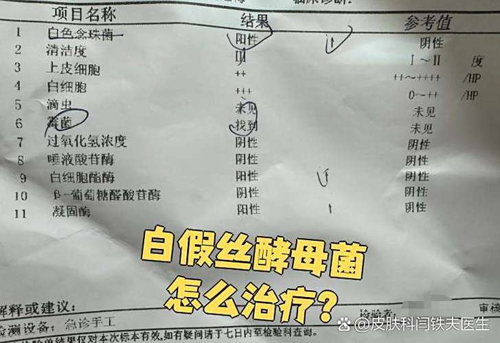 白色念珠菌是真菌吗缩略图