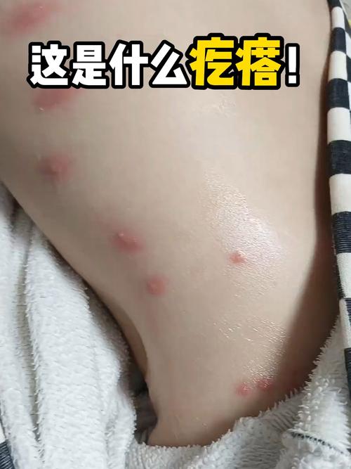 身上痒一挠就起红疙瘩是怎么回事缩略图