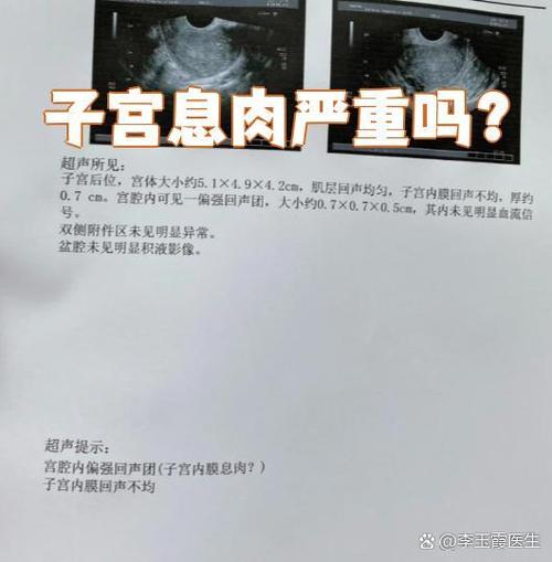 子宫息肉严重吗缩略图