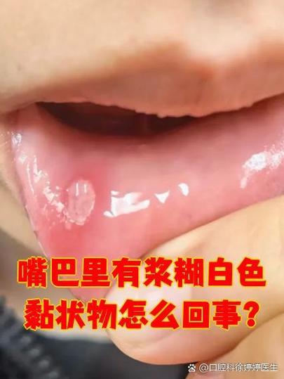 口腔总是黏糊糊的怎么办缩略图