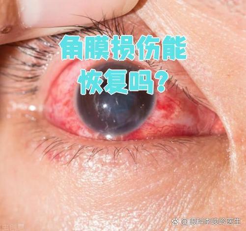 虹膜损伤对眼睛的伤害缩略图