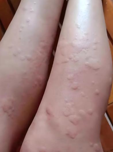 浑身瘙痒起疙瘩是怎么回事缩略图