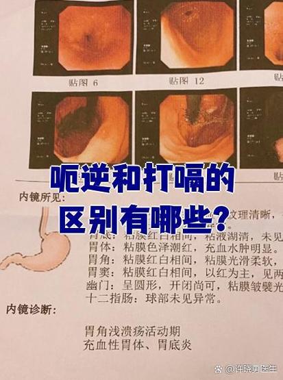 呃逆和打嗝的区别缩略图