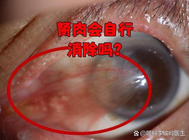 异形胬肉缩略图