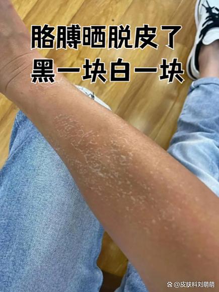皮肤白一块黑一块是什么原因游戏截图
