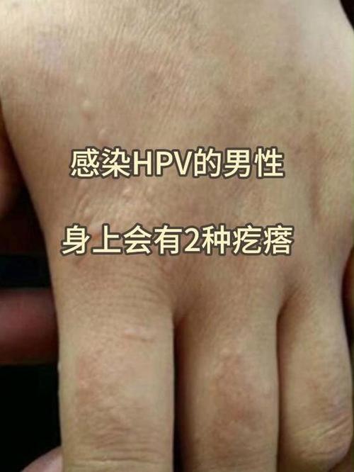 男性hpv初期小红点缩略图