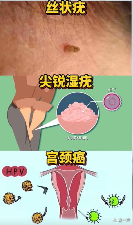 什么是hpv缩略图