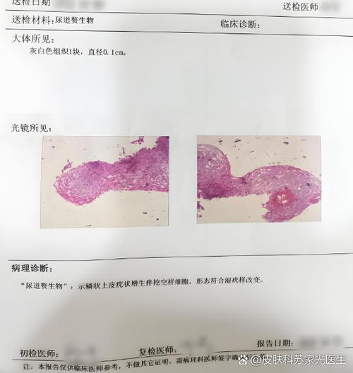 低危hpv42阳性是什么意思,严重吗缩略图