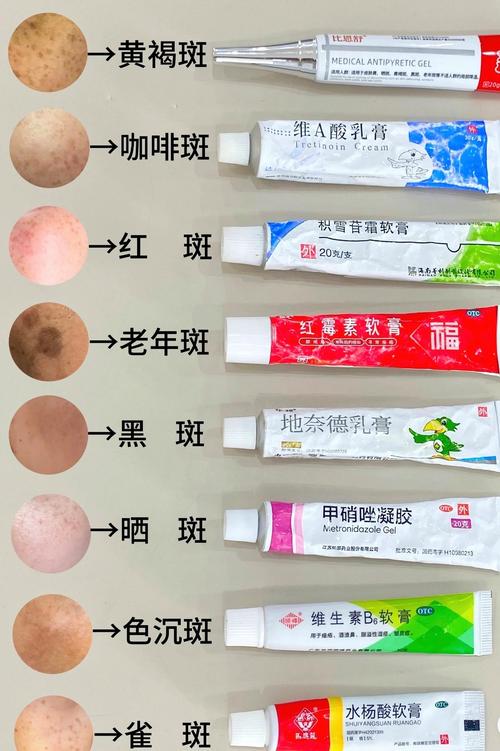 怎么看祛斑霜有激素缩略图