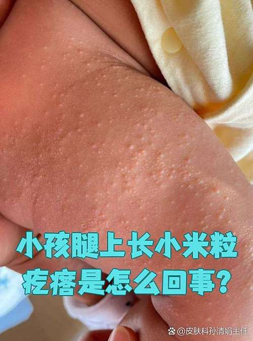 小米粒似的疙瘩图片游戏截图