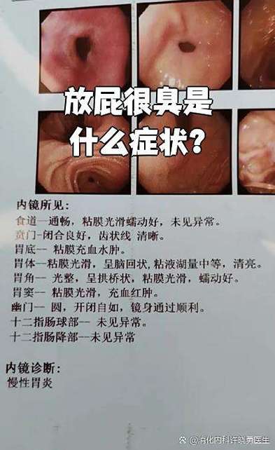 放屁越臭越说明什么缩略图
