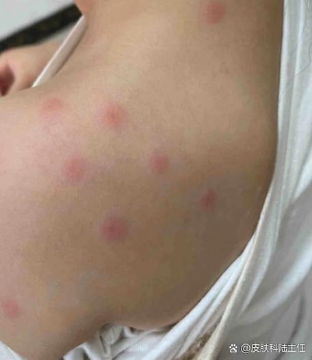身体上起了很多红疙瘩很痒缩略图