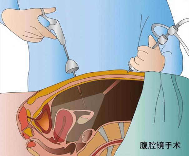 宫腹腔镜联合输卵管疏通术多少钱缩略图
