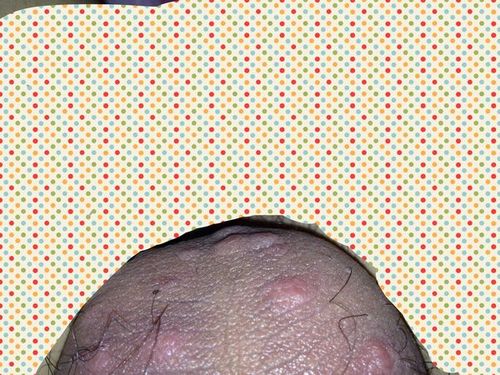 蛋皮上有疙瘩很痒缩略图