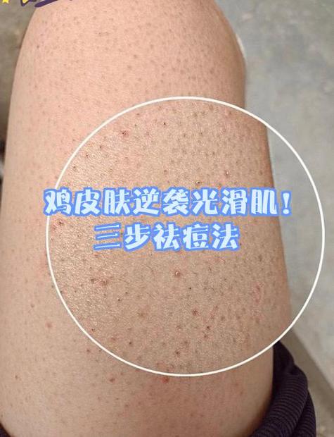 皮肤变成鸡皮肤原因缩略图