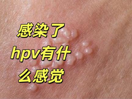 hpv的疣体长什么样子缩略图