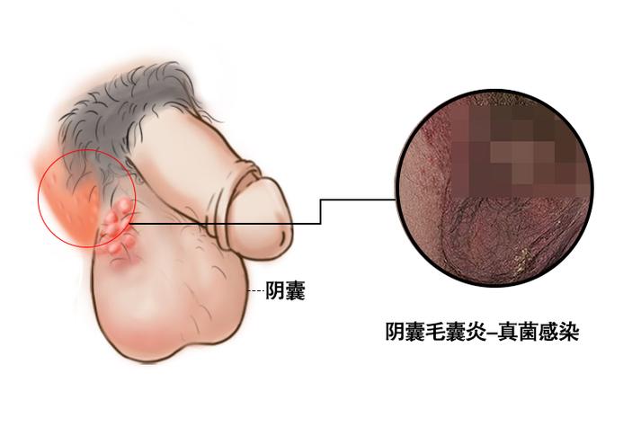 男性真菌感染症状图片缩略图