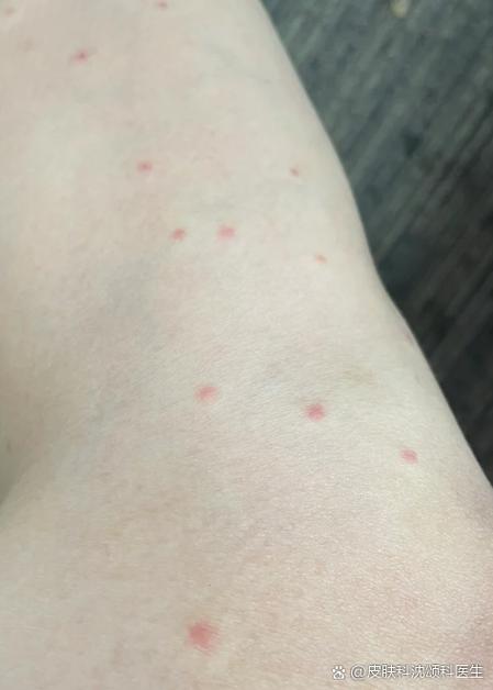 皮肤过敏起红点点缩略图