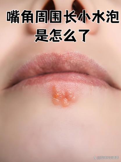 水泡和疱疹的区别图片缩略图