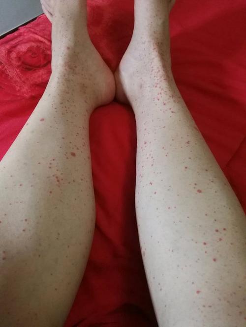 皮下出现红色血点缩略图