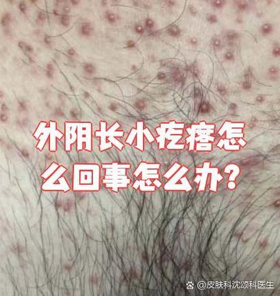 女生下面长了小疙瘩怎么回事缩略图