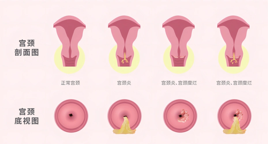 宫颈hpv感染阳性缩略图