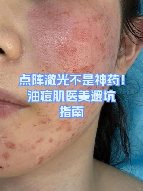 为什么医生不建议点阵激光缩略图
