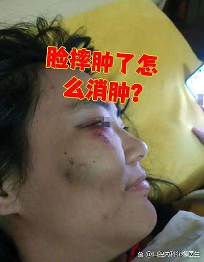 脸摔跤肿了怎么消肿最快缩略图