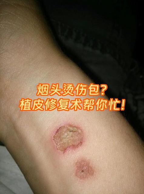 烫伤后皮被搓掉了缩略图