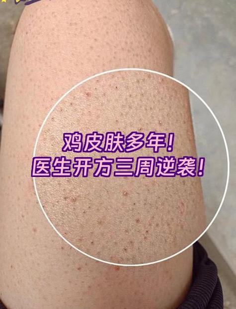鸡皮肤一般寿命多少年缩略图