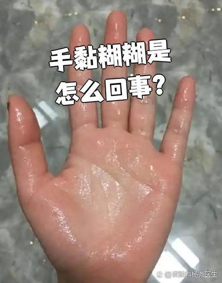 手黏糊糊是怎么回事缩略图