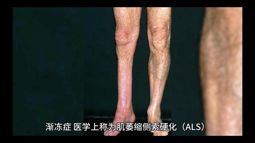 als是什么疾病缩略图