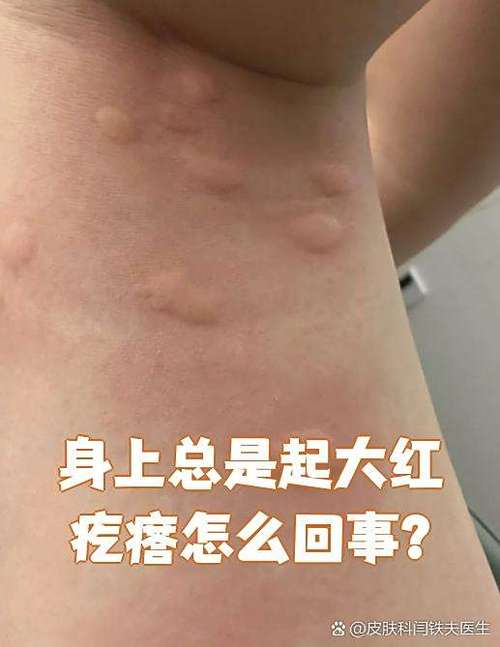 我身上起了红疙瘩特痒的缩略图